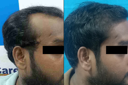 hair transplant treatment - vcare