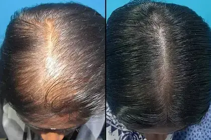 hair transplant treatment - vcare