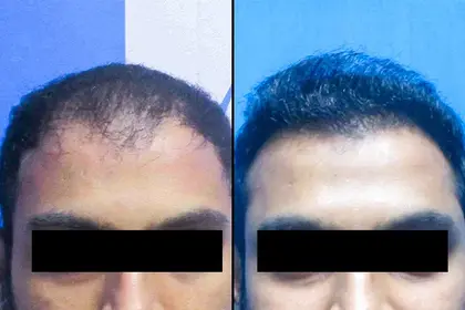 hair transplant treatment - vcare