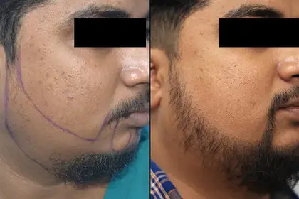 hair transplant treatment - vcare
