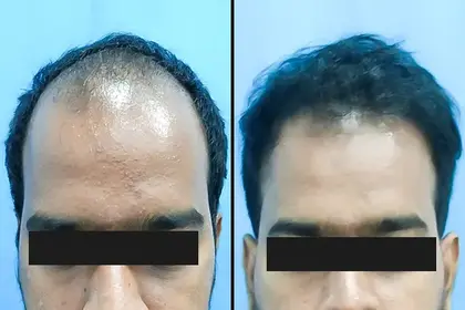 hair transplant treatment - vcare