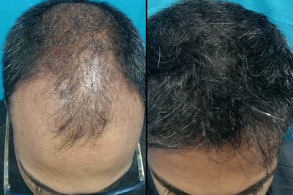 hair transplant treatment - vcare