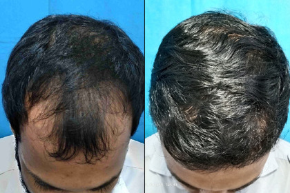 hair transplant treatment - vcare